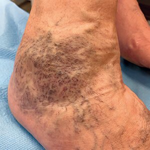 orvosság a visszeres lábak fájdalmára visszér műtét fotó