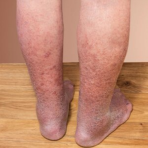 A vádlifájdalom 10 lehetséges oka, Görcsös és zsibbadt lábak visszeres