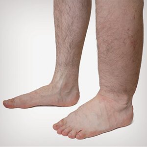 visszér a lábfájdalom tünetei